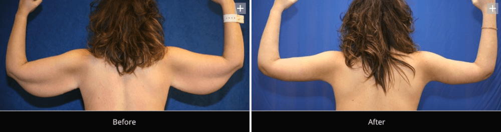 Back Arm Lift